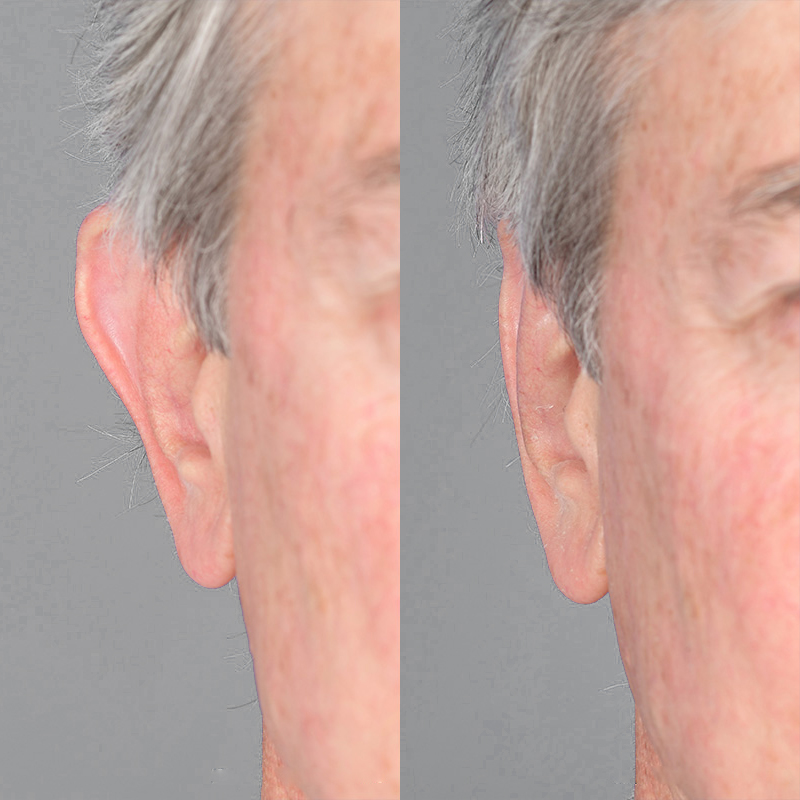 Before After 2